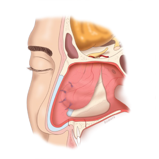 Reparaci N De Perforaci N Septal De Ltima Generaci N Secpf